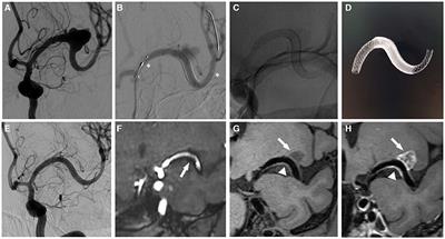 Usefulness of 3D T1-SPACE in Combination With 3D-TOF MRA for Follow-Up Evaluation of Intracranial Aneurysms Treated With Pipeline Embolization Devices